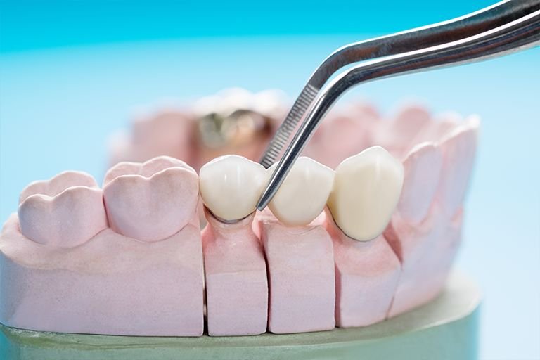 Dental crowns and bridges at Best Smilles
